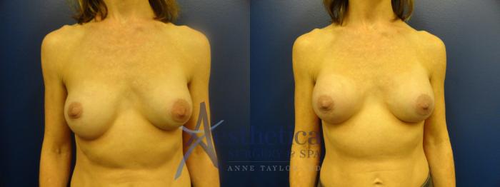 Breast Augmentation Revision Case 107 Before & After View #1 | Columbus, OH | Aesthetica Surgery & Spa
