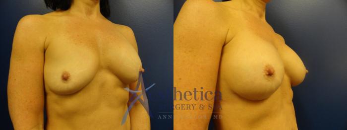 Breast Augmentation Revision Case 109 Before & After View #1 | Columbus, OH | Aesthetica Surgery & Spa