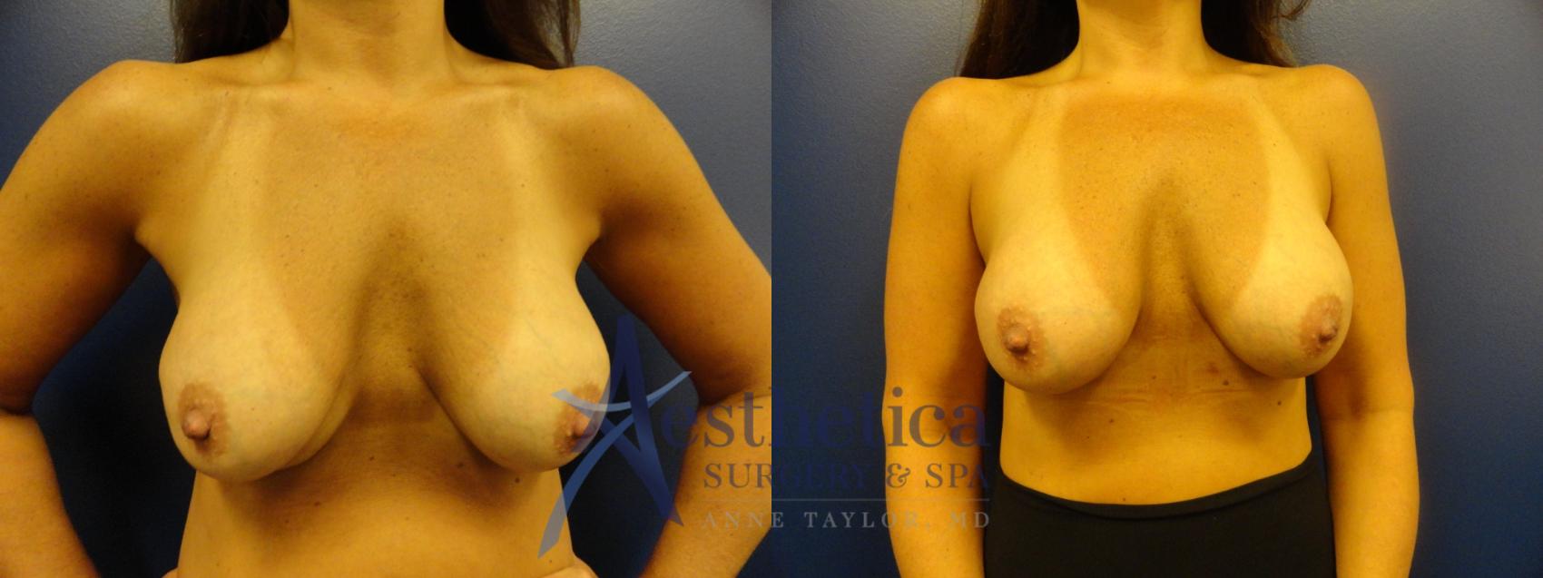 Breast Augmentation Revision Case 111 Before & After View #1 | Columbus, OH | Aesthetica Surgery & Spa