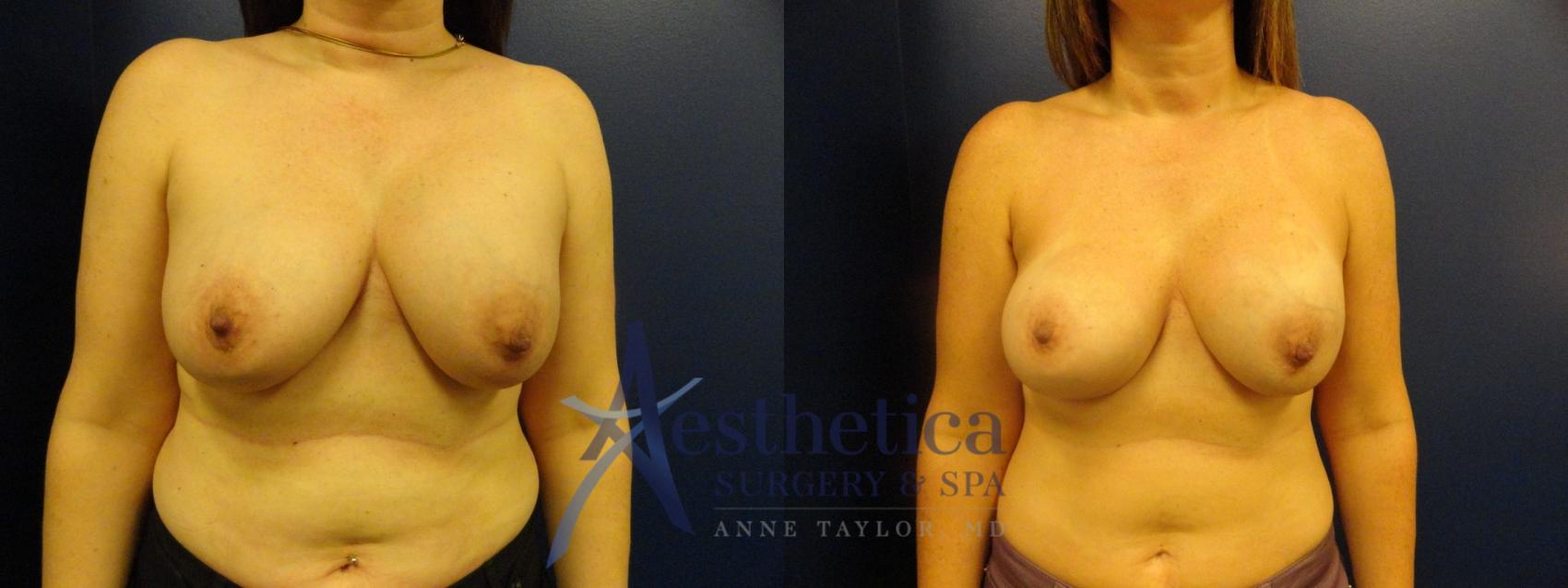Breast Augmentation Revision Case 273 Before & After View #1 | Columbus, OH | Aesthetica Surgery & Spa
