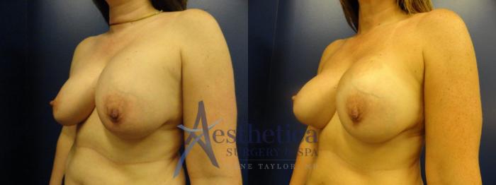 Breast Augmentation Revision Case 273 Before & After View #2 | Columbus, OH | Aesthetica Surgery & Spa