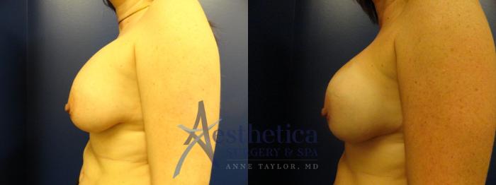 Breast Augmentation Revision Case 273 Before & After View #3 | Columbus, OH | Aesthetica Surgery & Spa