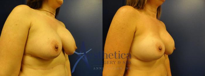 Breast Augmentation Revision Case 273 Before & After View #4 | Columbus, OH | Aesthetica Surgery & Spa
