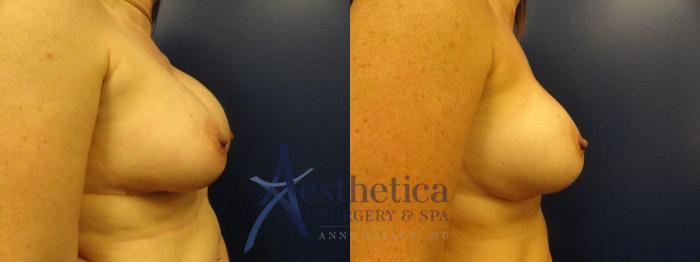 Breast Augmentation Revision Case 273 Before & After View #5 | Columbus, OH | Aesthetica Surgery & Spa
