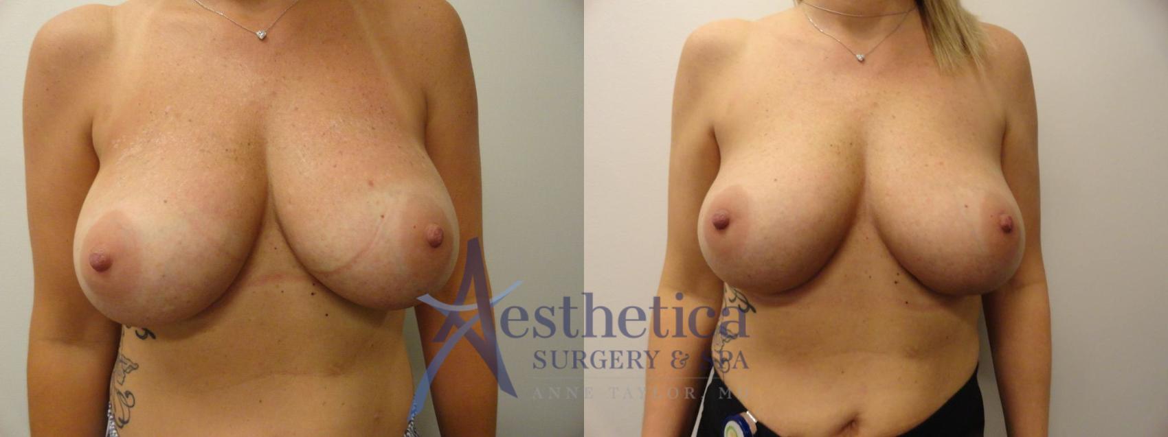 Breast Augmentation Revision Case 282 Before & After View #1 | Columbus, OH | Aesthetica Surgery & Spa