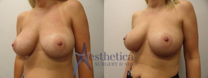Breast Augmentation Revision Case 282 Before & After View #2 | Columbus, OH | Aesthetica Surgery & Spa