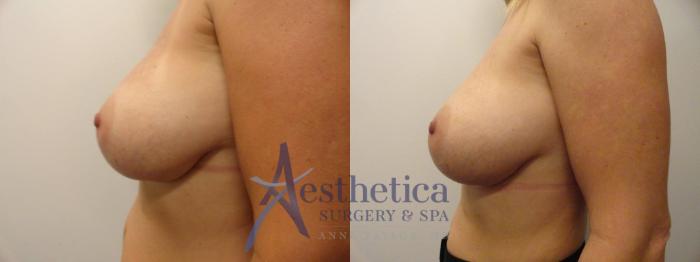 Breast Augmentation Revision Case 282 Before & After View #3 | Columbus, OH | Aesthetica Surgery & Spa