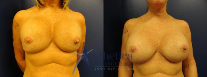 Breast Augmentation Revision Case 290 Before & After View #1 | Columbus, OH | Aesthetica Surgery & Spa