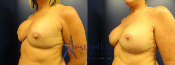 Breast Augmentation Revision Case 290 Before & After View #2 | Columbus, OH | Aesthetica Surgery & Spa