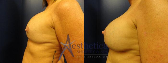 Breast Augmentation Revision Case 290 Before & After View #3 | Columbus, OH | Aesthetica Surgery & Spa