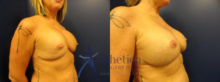 Breast Augmentation Revision Case 290 Before & After View #4 | Columbus, OH | Aesthetica Surgery & Spa