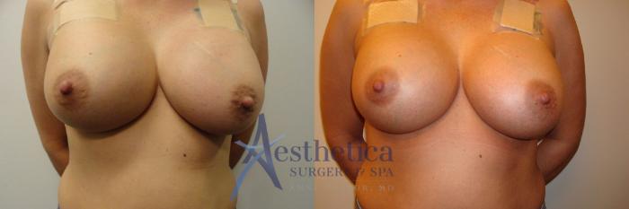 Breast Augmentation Revision Case 307 Before & After View #1 | Columbus, OH | Aesthetica Surgery & Spa