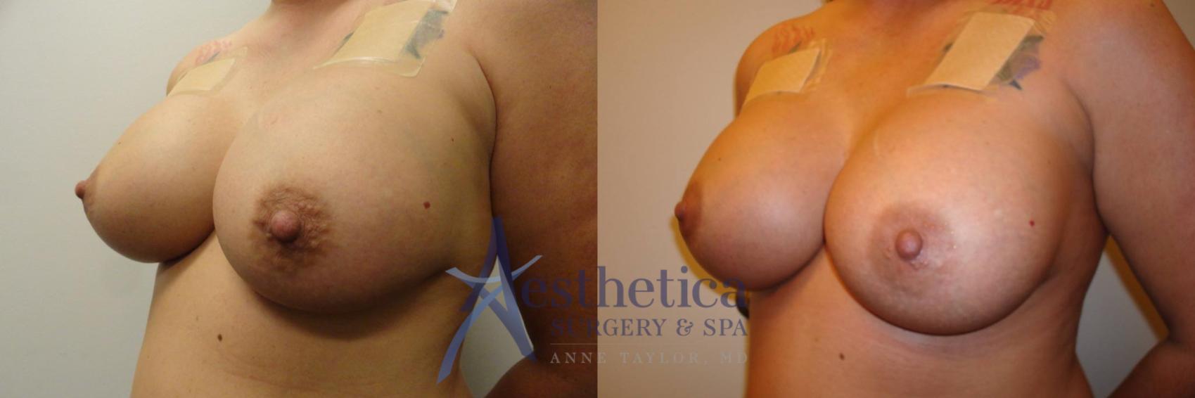Breast Augmentation Revision Case 307 Before & After View #2 | Columbus, OH | Aesthetica Surgery & Spa