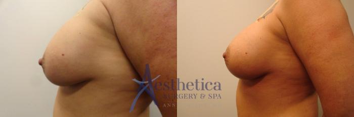 Breast Augmentation Revision Case 307 Before & After View #3 | Columbus, OH | Aesthetica Surgery & Spa
