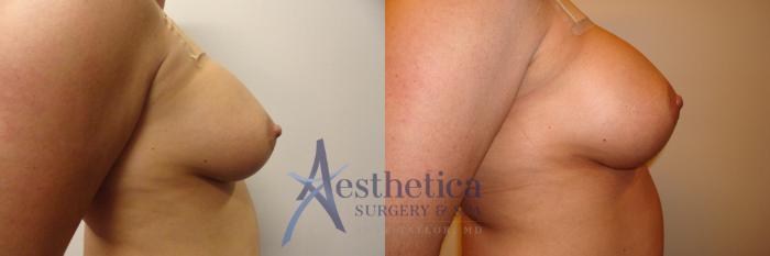 Breast Augmentation Revision Case 307 Before & After View #5 | Columbus, OH | Aesthetica Surgery & Spa