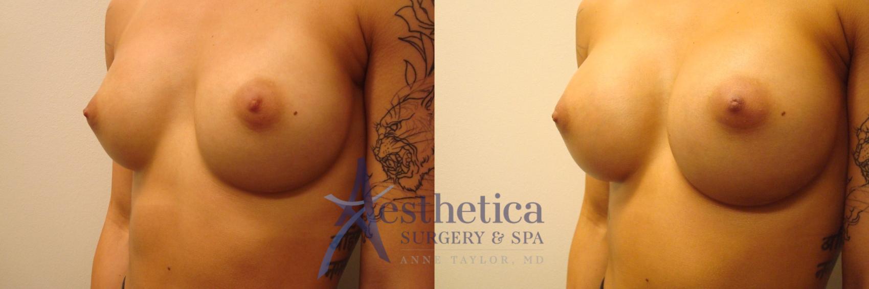 Breast Augmentation Revision Case 314 Before & After View #2 | Worthington, OH | Aesthetica Surgery & Spa