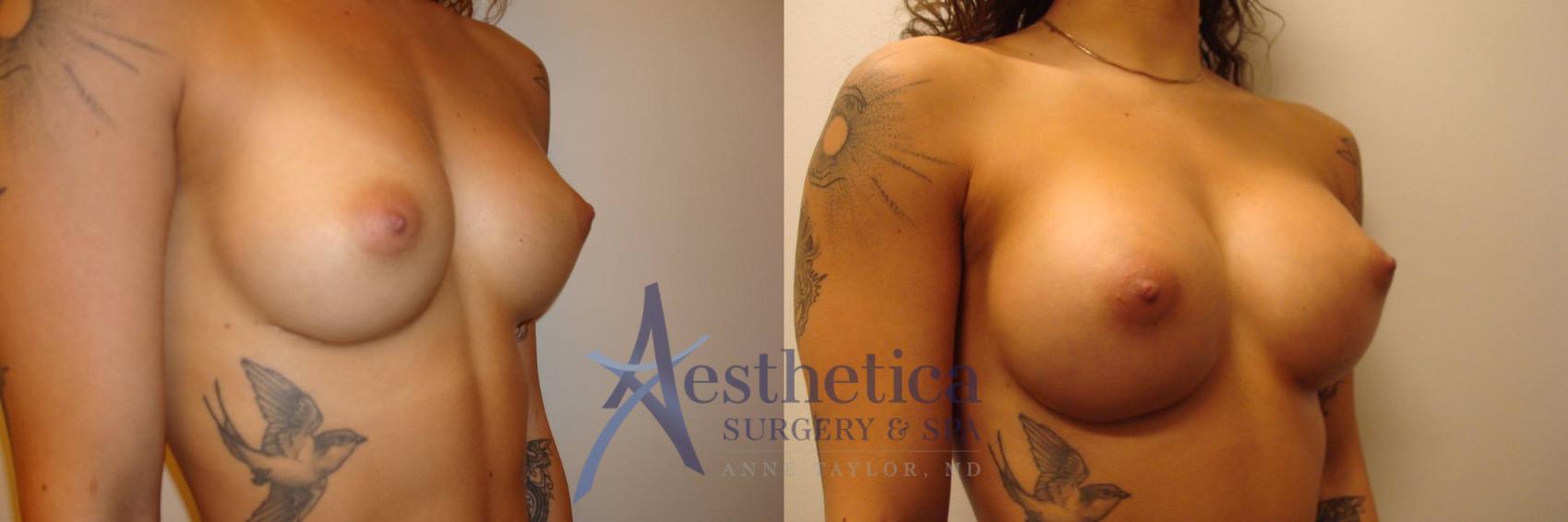 Breast Augmentation Revision Case 314 Before & After View #4 | Worthington, OH | Aesthetica Surgery & Spa