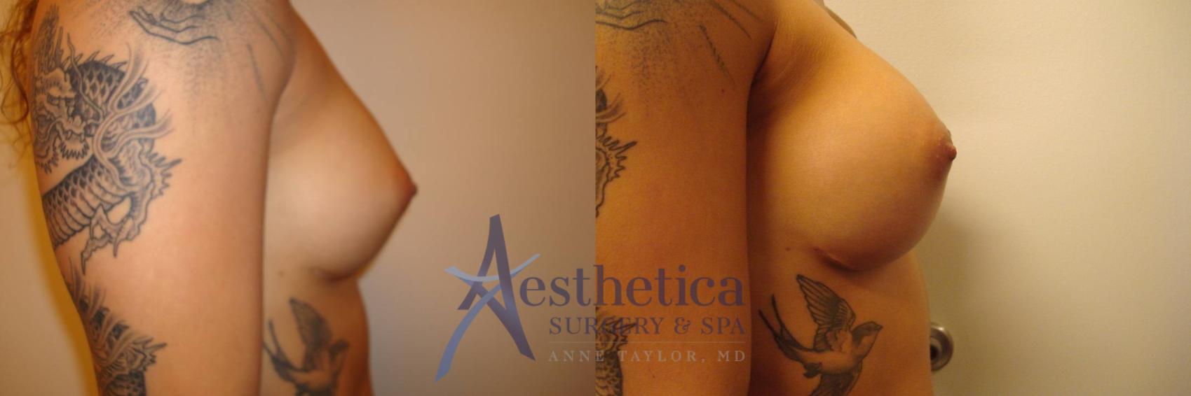 Breast Augmentation Revision Case 314 Before & After View #5 | Worthington, OH | Aesthetica Surgery & Spa