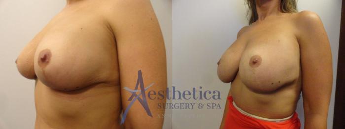 Breast Augmentation Revision Case 325 Before & After View #2 | Columbus, OH | Aesthetica Surgery & Spa