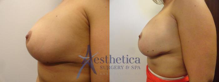 Breast Augmentation Revision Case 325 Before & After View #3 | Columbus, OH | Aesthetica Surgery & Spa