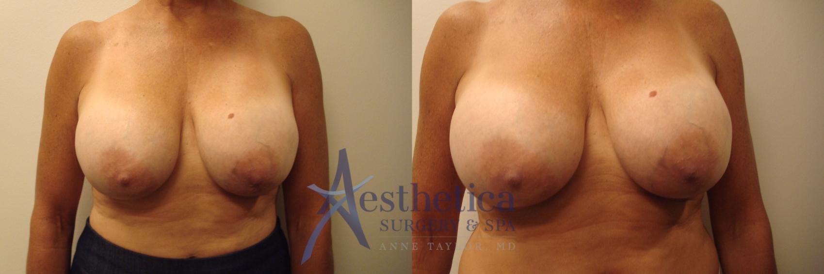 Breast Augmentation Revision Case 363 Before & After View #1 | Columbus, OH | Aesthetica Surgery & Spa