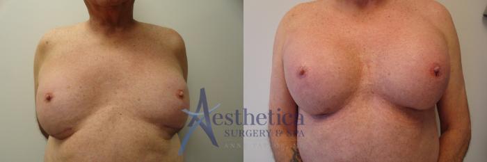 Breast Augmentation Revision Case 418 Before & After View #1 | Columbus, OH | Aesthetica Surgery & Spa