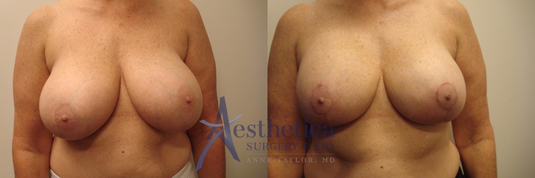 Breast Augmentation Revision Case 422 Before & After View #1 | Columbus, OH | Aesthetica Surgery & Spa