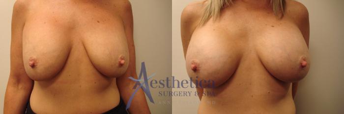 Breast Augmentation Revision Case 426 Before & After View #1 | Columbus, OH | Aesthetica Surgery & Spa