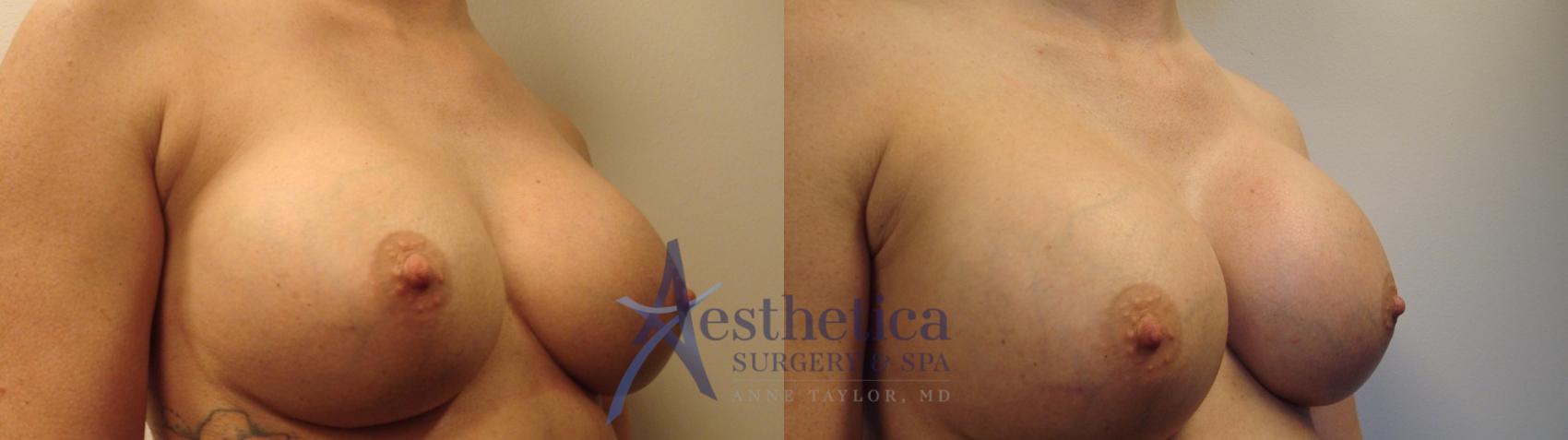 Breast Augmentation Revision Case 458 Before & After Right Oblique | Worthington, OH | Aesthetica Surgery & Spa