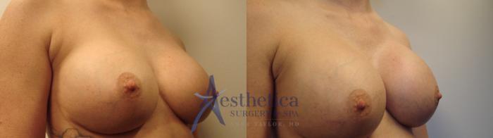 Breast Augmentation Revision Case 458 Before & After Right Oblique | Columbus, OH | Aesthetica Surgery & Spa