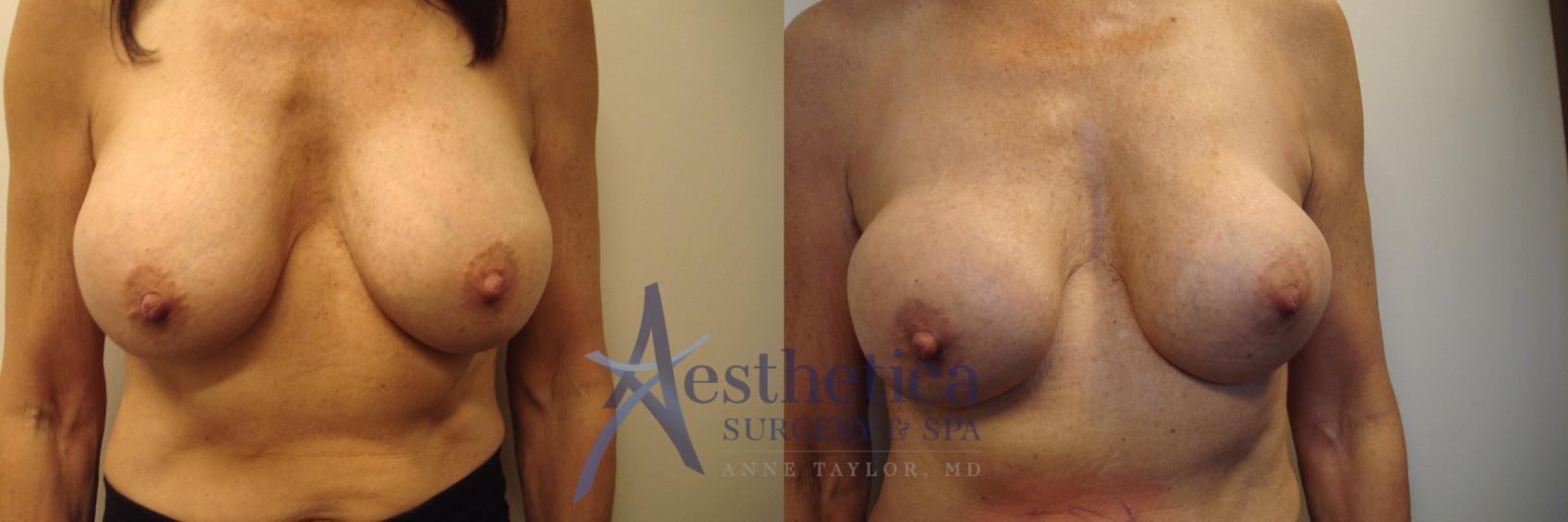 Breast Augmentation Revision Case 485 Before & After Front | Worthington, OH | Aesthetica Surgery & Spa