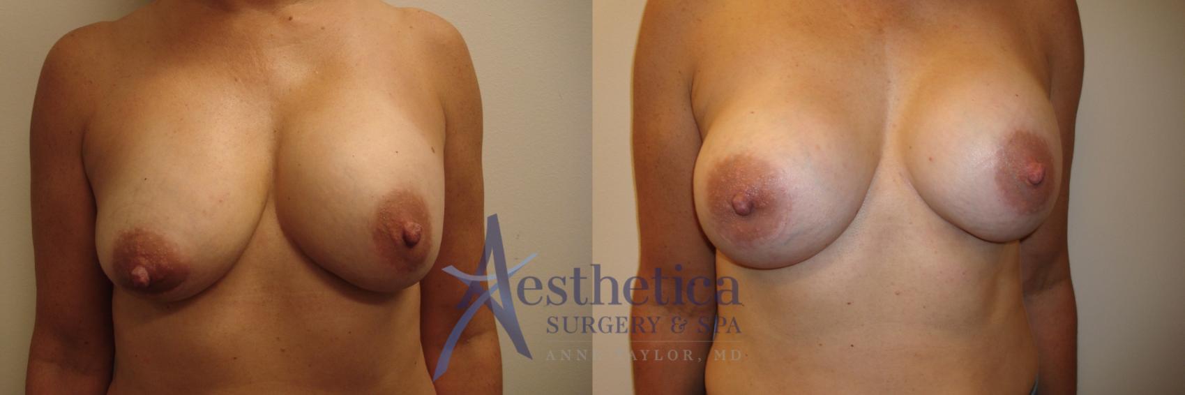Breast Augmentation Revision Case 532 Before & After Front | Worthington, OH | Aesthetica Surgery & Spa