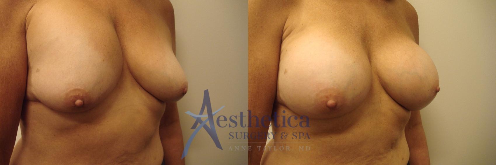 Breast Augmentation Revision Case 534 Before & After Right Oblique | Worthington, OH | Aesthetica Surgery & Spa
