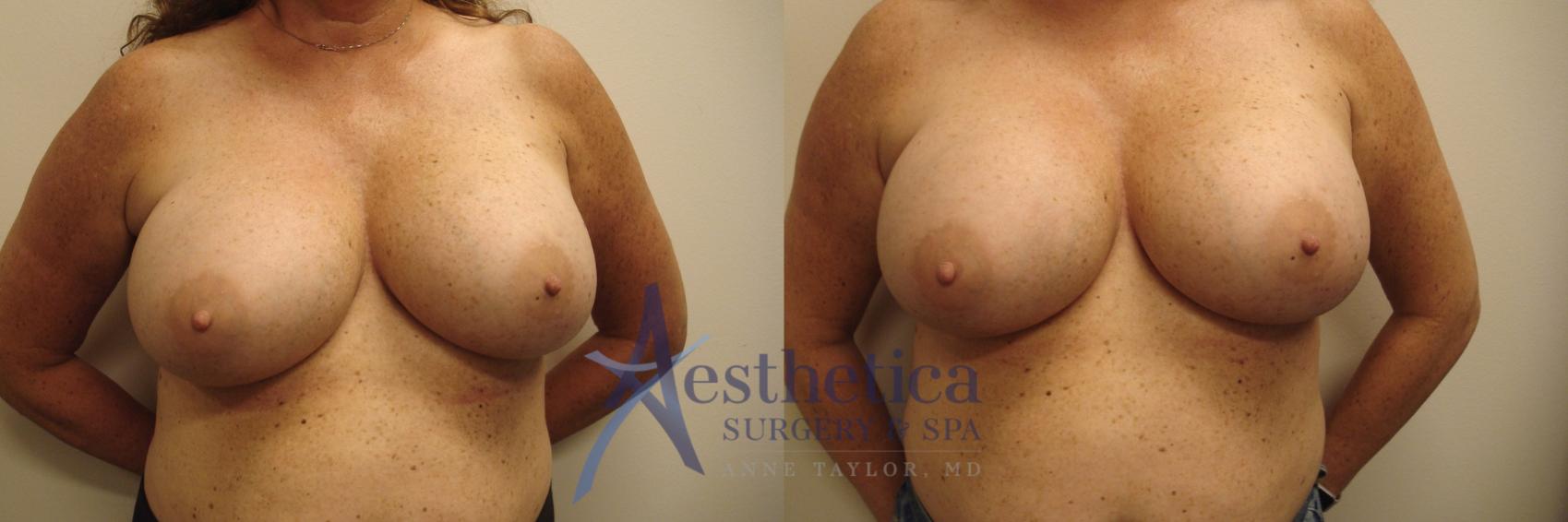 Breast Augmentation Revision Case 547 Before & After Front | Worthington, OH | Aesthetica Surgery & Spa