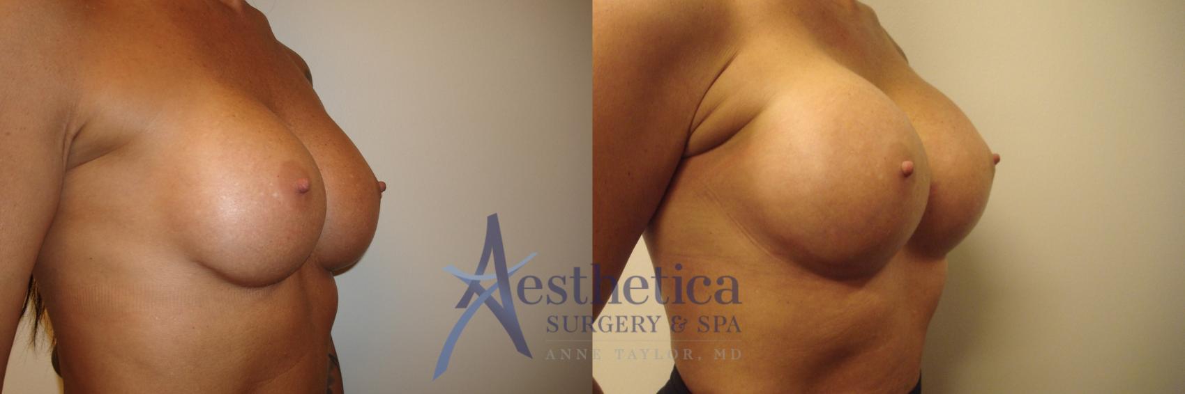 Breast Augmentation Revision Case 549 Before & After Right Side | Worthington, OH | Aesthetica Surgery & Spa