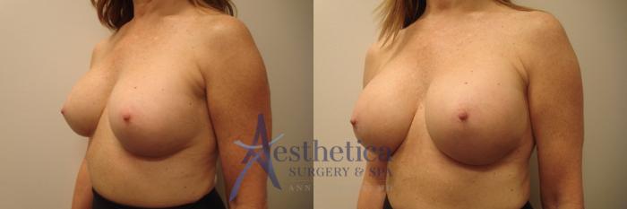 Breast Augmentation Revision Case 553 Before & After Left Oblique | Columbus, OH | Aesthetica Surgery & Spa