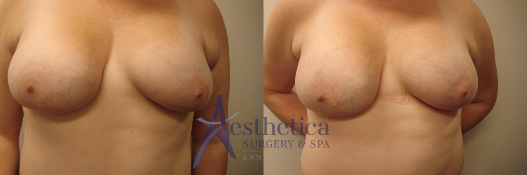 Breast Augmentation Revision Case 571 Before & After Front | Columbus, OH | Aesthetica Surgery & Spa