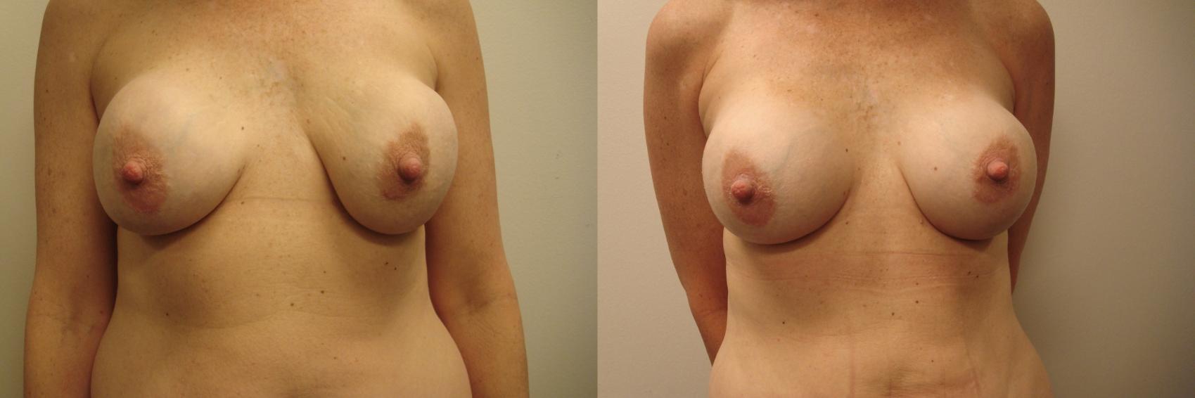 Breast Augmentation Revision Case 603 Before & After Front | Columbus, OH | Aesthetica Surgery & Spa