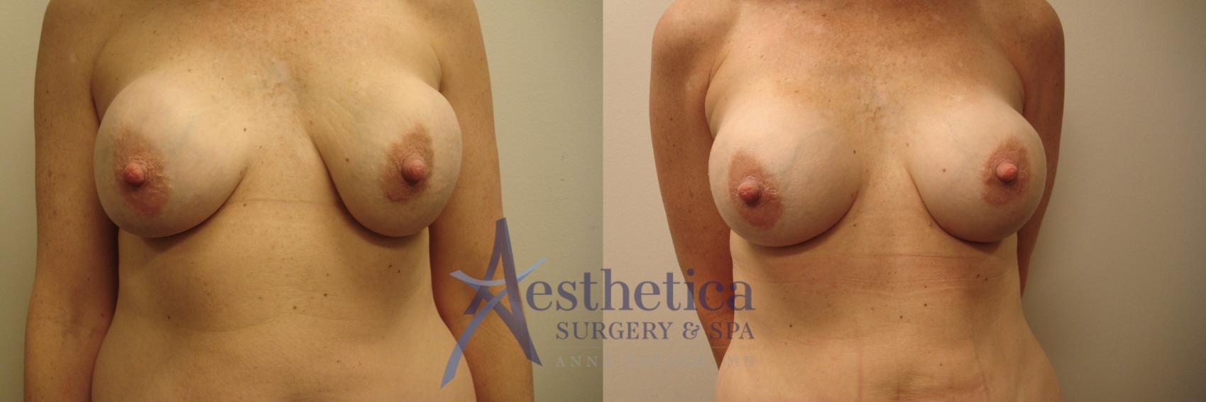 Breast Augmentation Revision Case 605 Before & After Front | Columbus, OH | Aesthetica Surgery & Spa