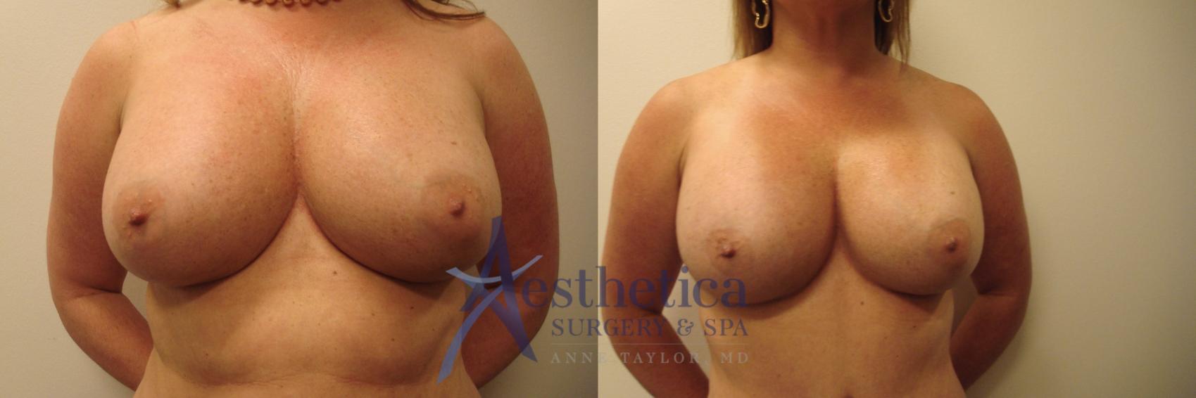 Breast Augmentation Revision Case 620 Before & After Front | Columbus, OH | Aesthetica Surgery & Spa