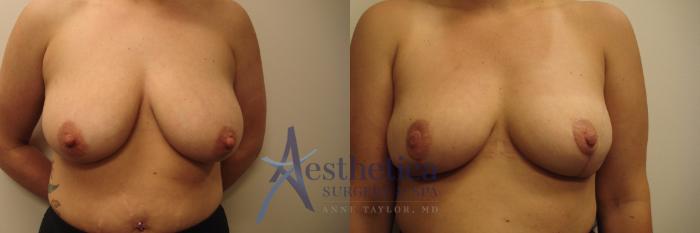 Breast Augmentation Revision Case 622 Before & After Front | Columbus, OH | Aesthetica Surgery & Spa