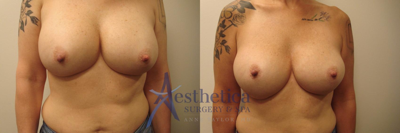 Breast Augmentation Revision Case 633 Before & After Front | Worthington, OH | Aesthetica Surgery & Spa