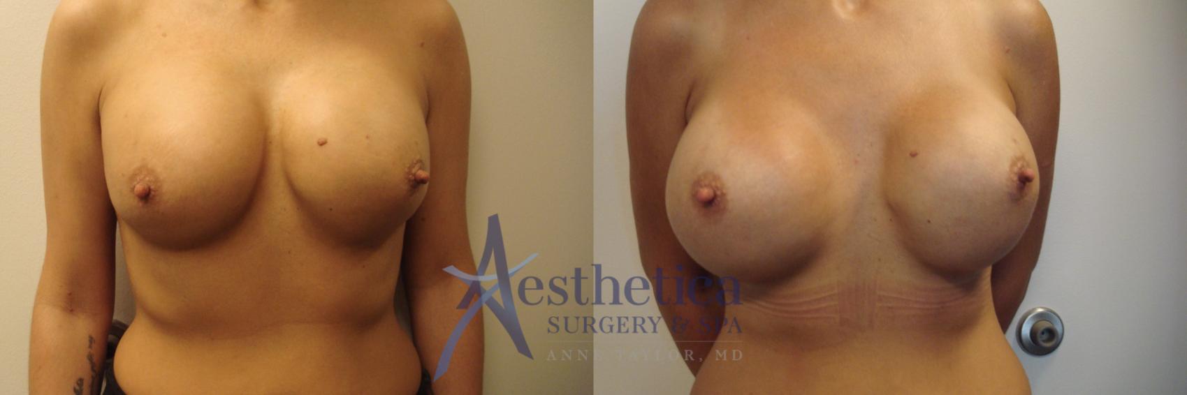 Breast Augmentation Revision Case 634 Before & After Front | Columbus, OH | Aesthetica Surgery & Spa