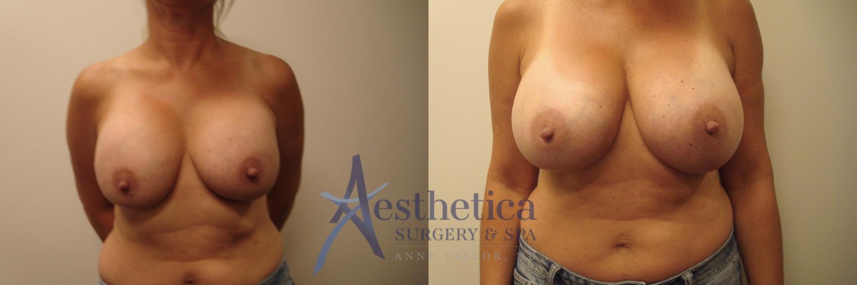 Breast Augmentation Revision Case 640 Before & After Front | Columbus, OH | Aesthetica Surgery & Spa