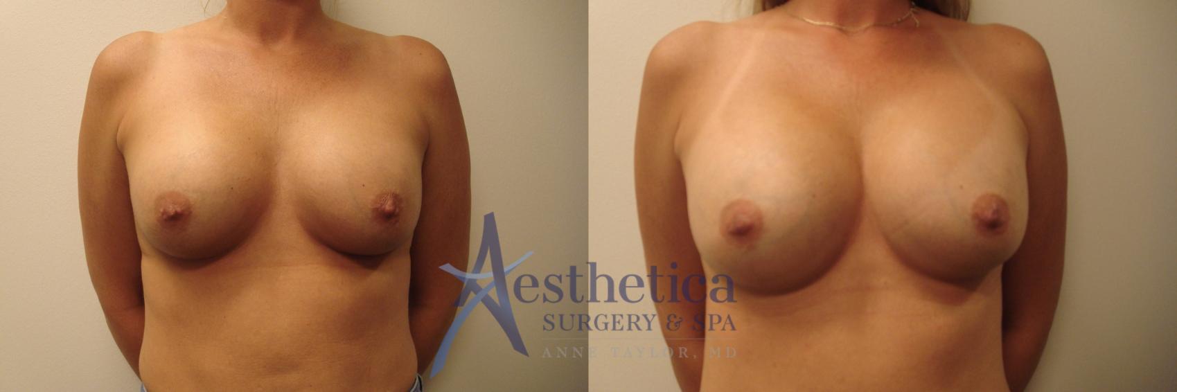 Breast Augmentation Revision Case 642 Before & After Front | Columbus, OH | Aesthetica Surgery & Spa