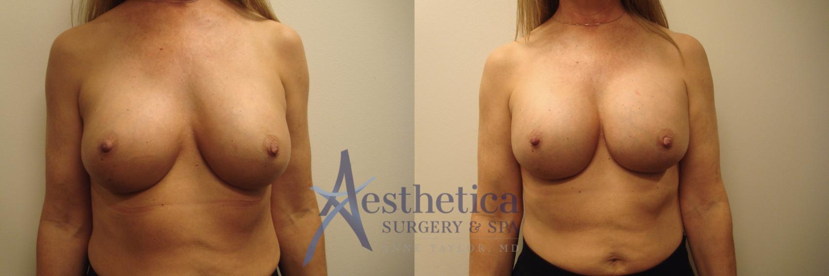 Breast Augmentation Revision Case 657 Before & After Front | Columbus, OH | Aesthetica Surgery & Spa