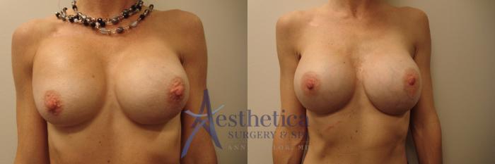 Breast Augmentation Revision Case 663 Before & After Front | Columbus, OH | Aesthetica Surgery & Spa