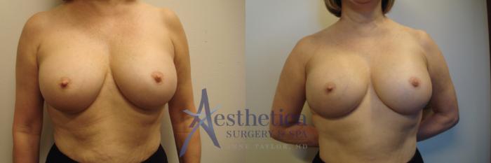 Breast Augmentation Revision Case 681 Before & After Front | Columbus, OH | Aesthetica Surgery & Spa
