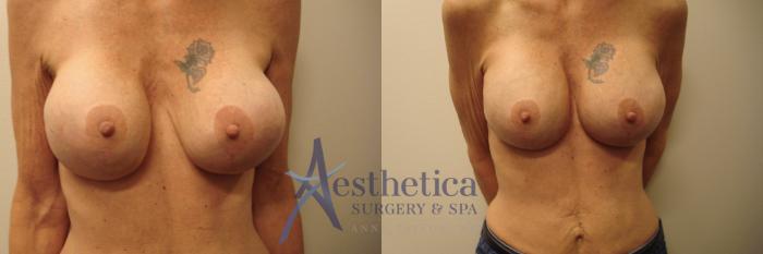 Breast Augmentation Revision Case 696 Before & After Front | Columbus, OH | Aesthetica Surgery & Spa