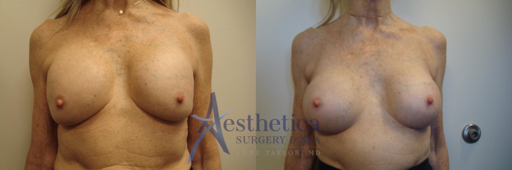 Breast Augmentation Revision Case 701 Before & After Front | Columbus, OH | Aesthetica Surgery & Spa
